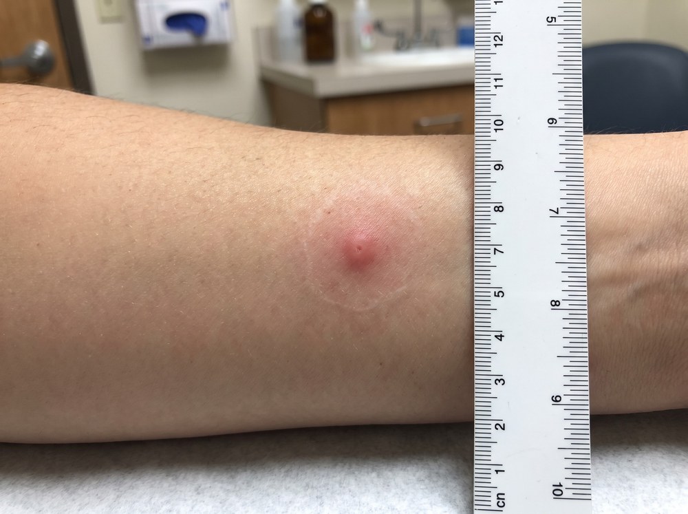 Close-up photo of a fresh carpenter ant bite showing a small red pinch mark with mild surrounding redness on skin