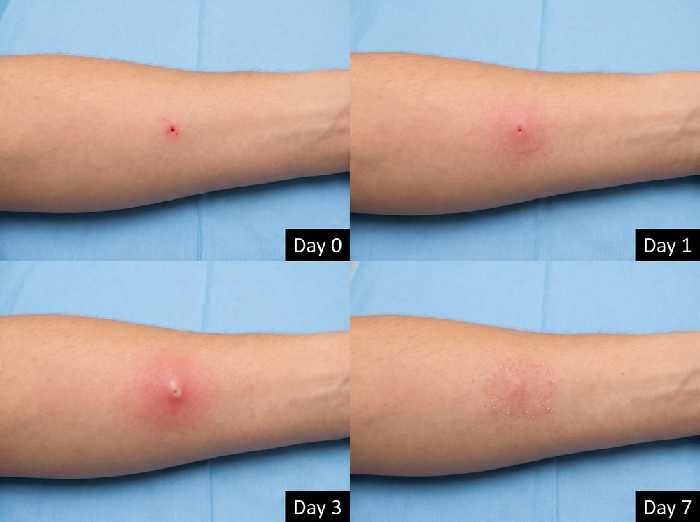 Side by side labeled comparison photo of a single carpenter ant bite mark next to a cluster of fire ant sting pustules